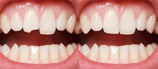 Composite Bonding | Whites Dental