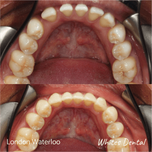 Invisalign braces before after | Orthodontist in London Waterloo 1 | Whites Dental