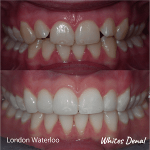 Invisalign braces before after | Orthodontist in London Waterloo 7 | Whites Dental