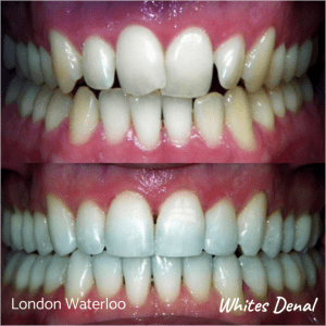 Invisalign braces before after | Orthodontist in London Waterloo 2 | Whites Dental