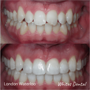 Invisalign braces before after | Orthodontist in London Waterloo 9 | Whites Dental