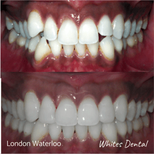 Invisalign braces before after | Orthodontist in London Waterloo 6 | Whites Dental