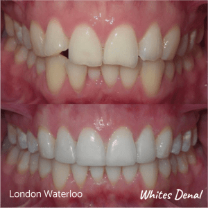 Invisalign braces before after | Orthodontist in London Waterloo 3 | Whites Dental
