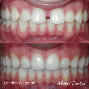 Invisalign braces before after | Orthodontist in London Waterloo 5 | Whites Dental