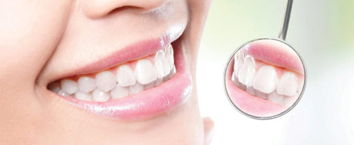 Smile Makeover | Whites Dental