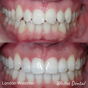 Is 35 Too Old For Braces orthodontist in london | Whites Dental