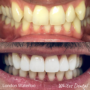Which braces are fastest orthodontist in london | Whites Dental
