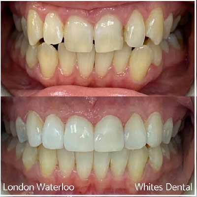 Is Invisalign More Painful Than Braces Invisalign in London | Whites Dental