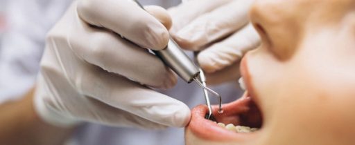 Is Invisalign Cheaper Than Braces Photo of Invisalign in London being fitted