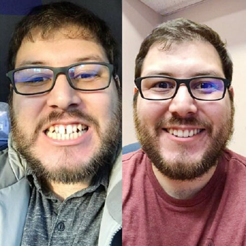 How do I find the best Invisalign dentist in London UK | Whites Dental