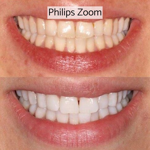 Teeth Whitening London - Philips Zoom Before And After 1